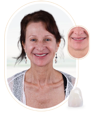 A before-and-after image of a patient with dental crowns in Mexico.