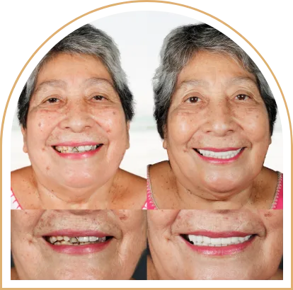 A before-and-after image of a patient with dental crowns in Mexico.