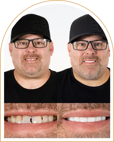 Professional root canal procedure being carried out by an expert dentist in Puerto Vallarta, Mexico.