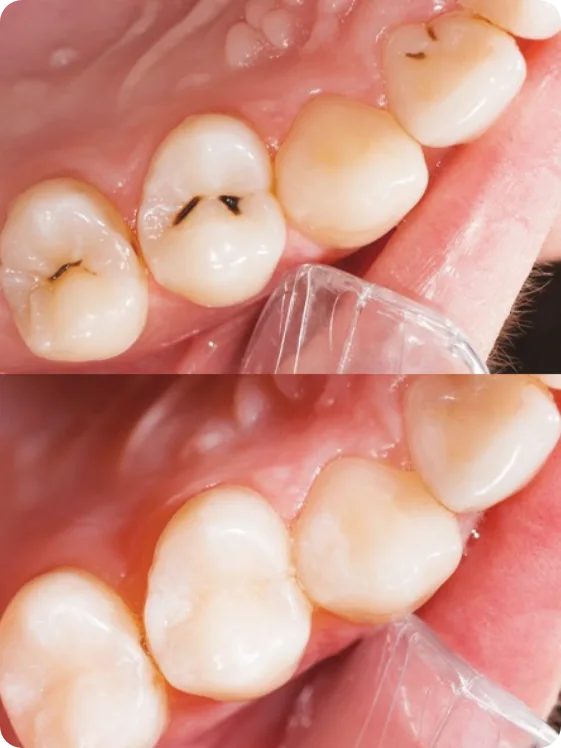 Common symptoms like pain or swelling that may indicate the need for a root canal, as identified by Puerto Vallarta dentists.