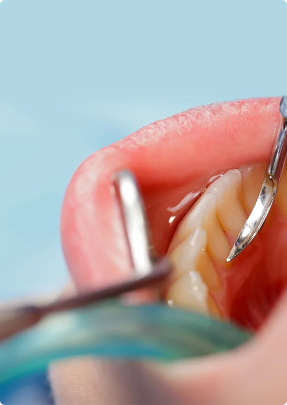 Featured image of five key things you should know before undergoing gum surgery