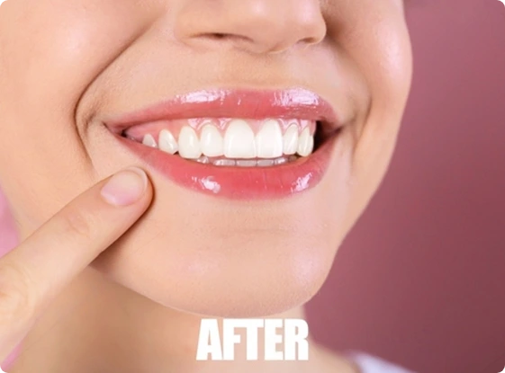 Explanatory photo on the benefits of gum surgery after certain treatments.