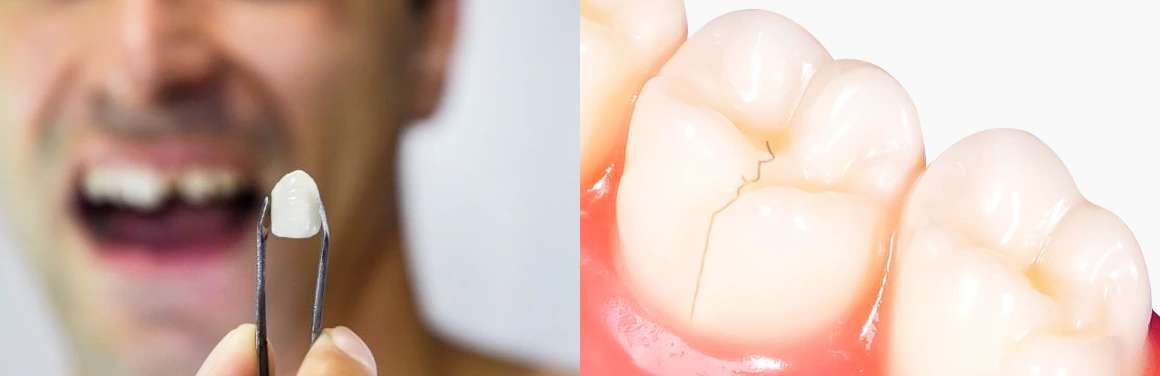 Side-by-side comparison of zirconia and titanium dental implants highlighting aesthetic and health benefits