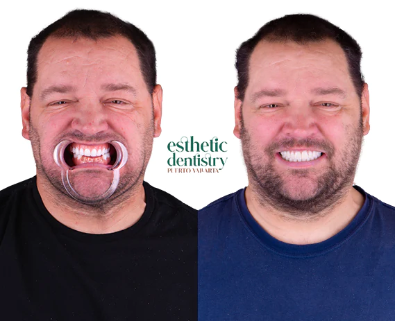 Before and after images of a patient showcasing the transformation with zirconia dental implants.